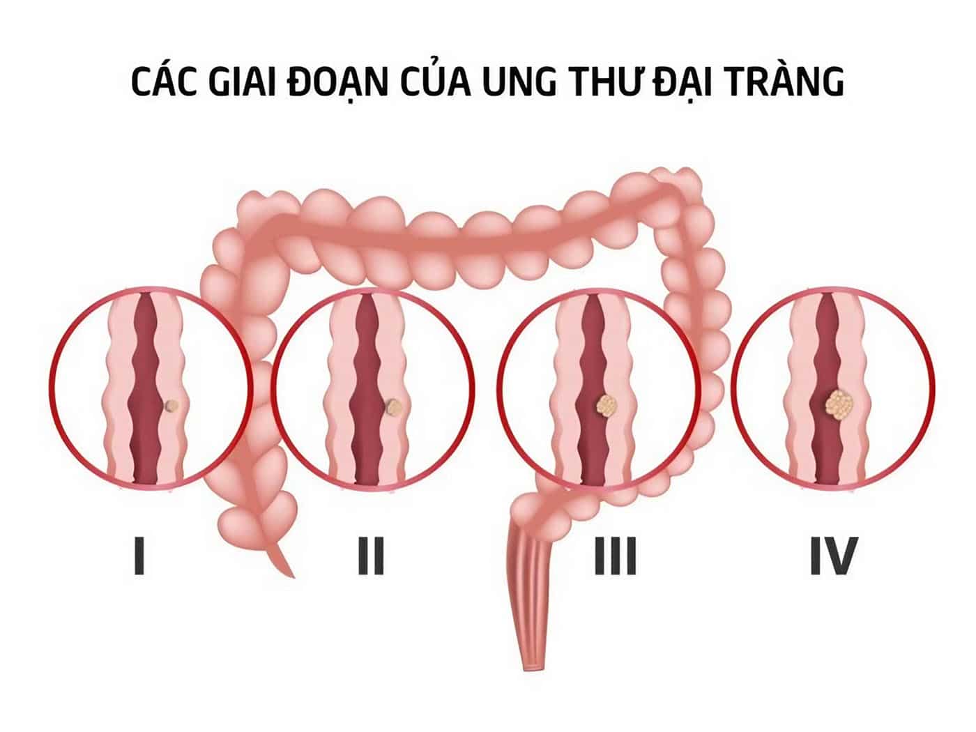 các giai đoạn của ung thư đại tràng