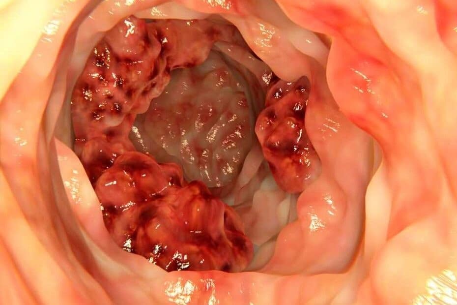 Phân loại ung thư hậu môn dựa vào vị trí, tình trạng khối u phát triển bao gồm kích thước và mức độ di căn của các tế bào ung thư. (Nguồn: expertchikitsa.com)